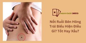 Nốt Ruồi Bên Hông Trái Biểu Hiện Điều Gì? Tốt Hay Xấu?